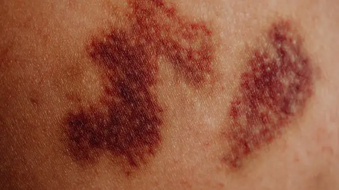 infected skin of a women
